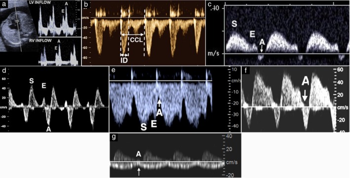 Hình 4. Đánh giá chức năng tâm trương bằng Doppler xung. (a) Dòng đổ đầy qua van hai lá và ba lá bình thường có hai pha