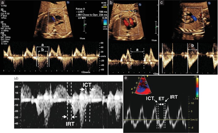 Hình 6. Đo chỉ số hoạt động cơ tim (MPI). (a) Thất trái: đặt cửa sổ Doppler trong buồng thất để ghi đồng thời dòng vào v